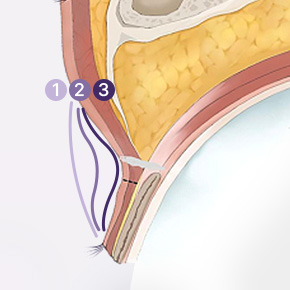 double eyelid revision surgery in korea rine plastic surgery