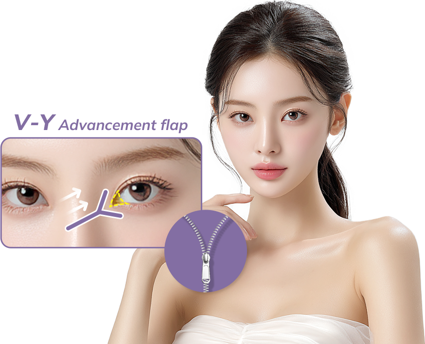 Epicanthoplasty Revision in Korea, RINE Plastic Surgery