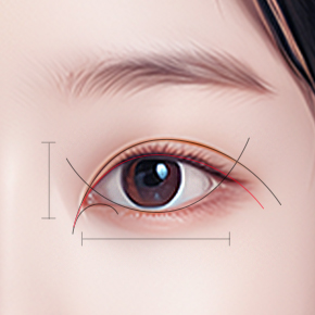 Non-Incisional Double Eyelid Surgery in Korea, RINE Plastic Surgery