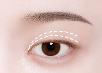 Non-Incisional Double Eyelid Surgery in Korea, RINE Plastic Surgery