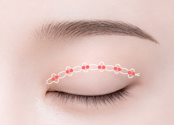 Non-Incisional Double Eyelid Surgery in Korea, RINE Plastic Surgery