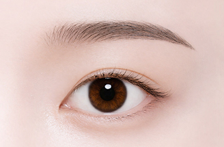Non-Incisional Double Eyelid Surgery in Korea, RINE Plastic Surgery