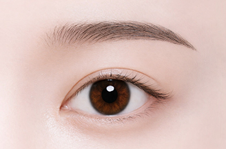Non-Incisional Double Eyelid Surgery in Korea, RINE Plastic Surgery