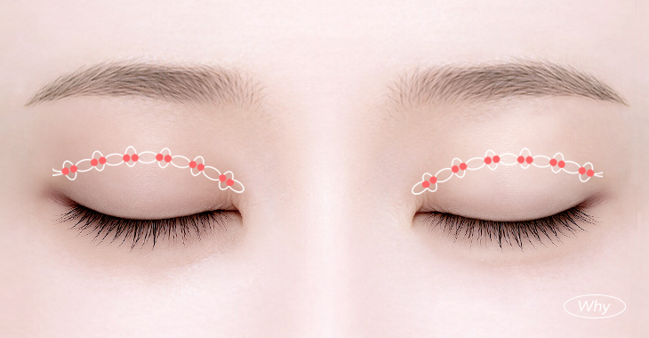 Non-Incisional Double Eyelid Surgery in Korea, RINE Plastic Surgery
