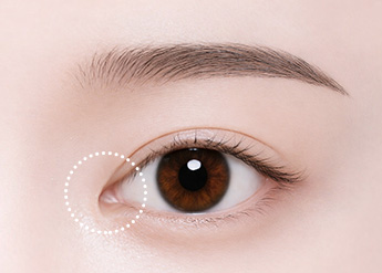 Epicanthoplasty Revision in Korea, RINE Plastic Surgery