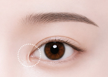 Epicanthoplasty Revision in Korea, RINE Plastic Surgery