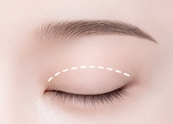 Ptosis Correction in Korea, RINE Plastic Surgery