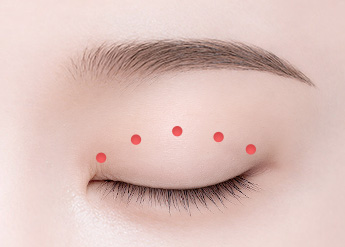 Ptosis Correction in Korea, RINE Plastic Surgery