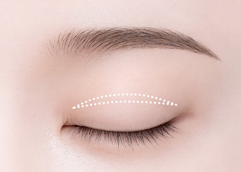 Ptosis Correction in Korea, RINE Plastic Surgery
