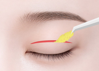 Ptosis Correction in Korea, RINE Plastic Surgery