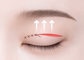 Ptosis Correction in Korea, RINE Plastic Surgery