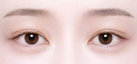 Ptosis Correction in Korea, RINE Plastic Surgery