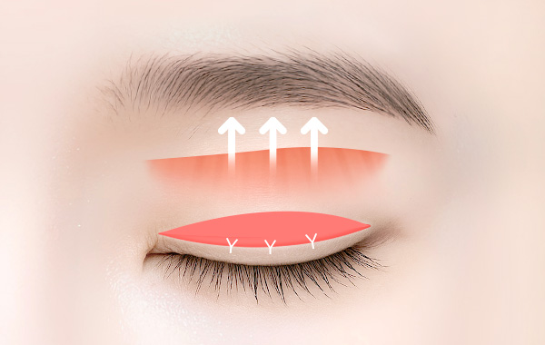 Ptosis Correction in Korea, RINE Plastic Surgery
