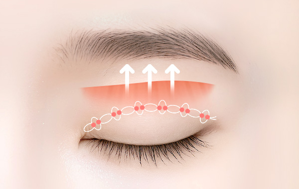 Ptosis Correction in Korea, RINE Plastic Surgery