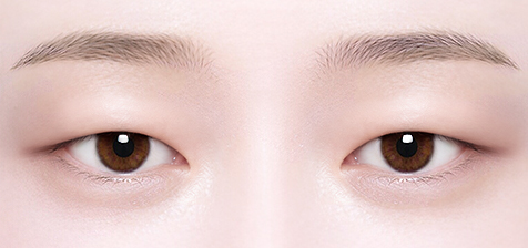 Double Eyelid Surgery in Korea, RINE Plastic Surgery