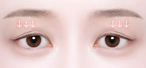 Double Eyelid Surgery in Korea, RINE Plastic Surgery
