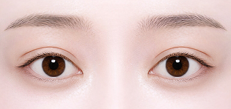 Double Eyelid Surgery in Korea, RINE Plastic Surgery