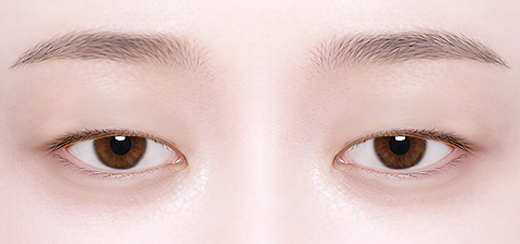 Ptosis Correction in Korea, RINE Plastic Surgery