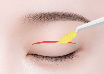 Double Eyelid Surgery in Korea, RINE Plastic Surgery
