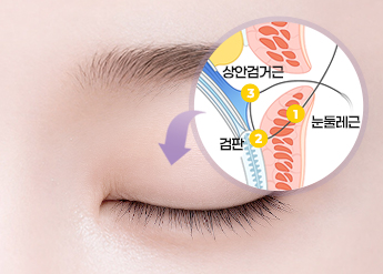 Double Eyelid Surgery in Korea, RINE Plastic Surgery
