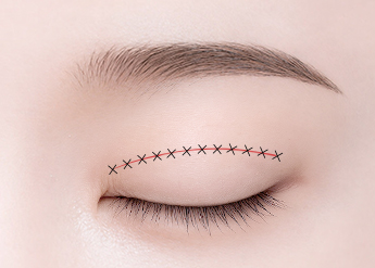 Double Eyelid Surgery in Korea, RINE Plastic Surgery