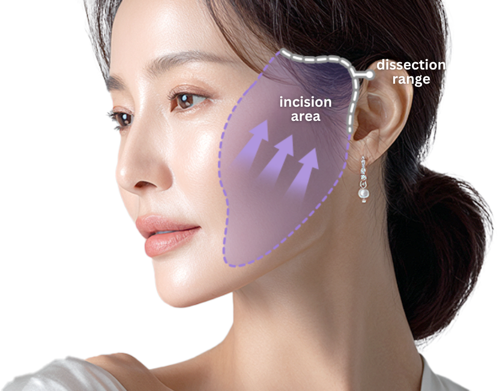 Minimally Invasive Facelift in Korea, RINE Plastic Surgery