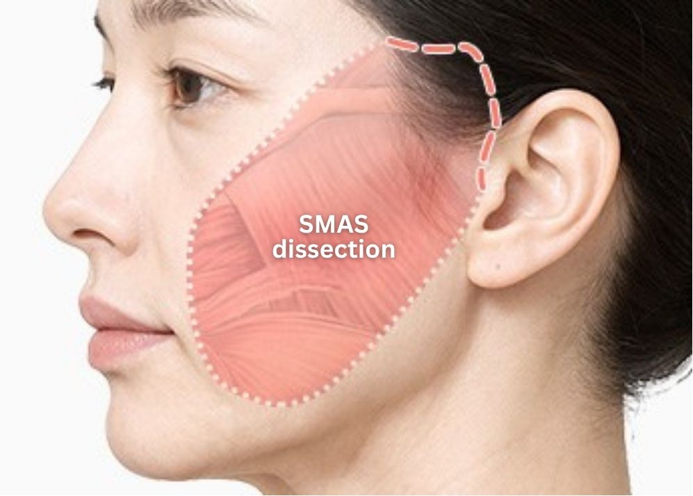 Minimally Invasive Facelift in Korea, RINE Plastic Surgery