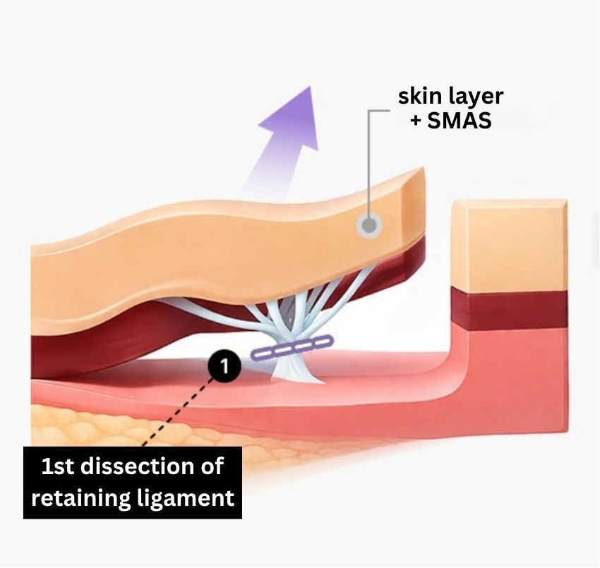 SMAS Face and Neck Lift in Korea, RINE Plastic Surgery
