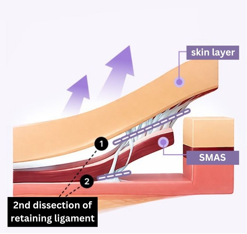 SMAS Face and Neck Lift in Korea, RINE Plastic Surgery