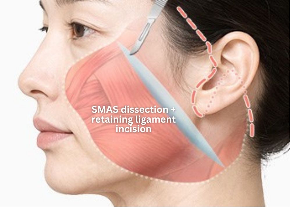 SMAS Face and Neck Lift in Korea, RINE Plastic Surgery