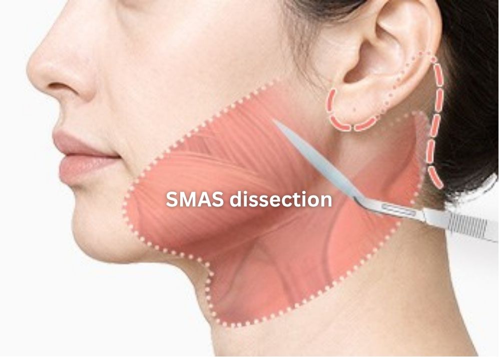 SMAS Face and Neck Lift in Korea, RINE Plastic Surgery