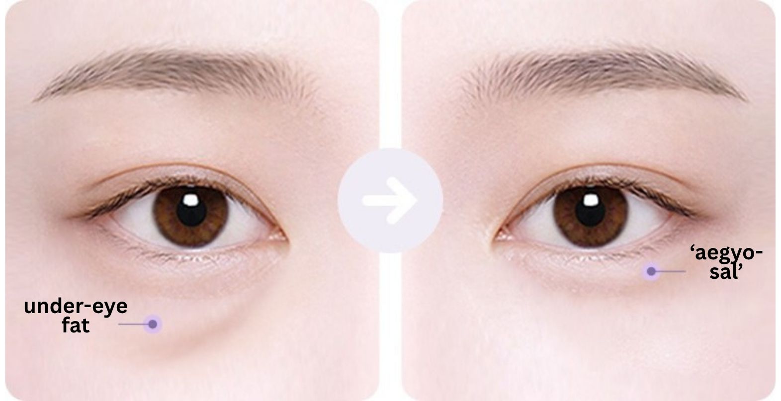 Under-eye Fat Repositioning in Korea, RINE Plastic Surgery