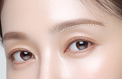 Sub-brow Lift in Korea, RINE Plastic Surgery