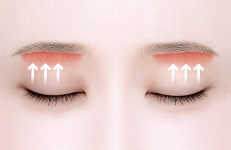 Sub-brow Lift in Korea, RINE Plastic Surgery