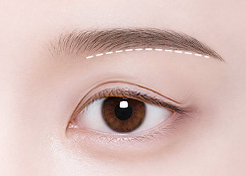Sub-brow Lift in Korea, RINE Plastic Surgery