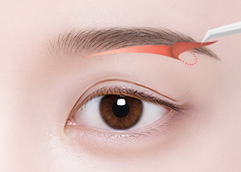 Sub-brow Lift in Korea, RINE Plastic Surgery