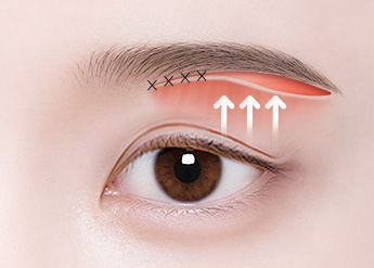 Sub-brow Lift in Korea, RINE Plastic Surgery