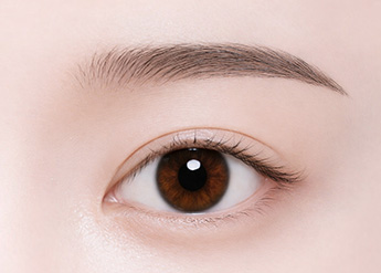 Sub-brow Lift in Korea, RINE Plastic Surgery