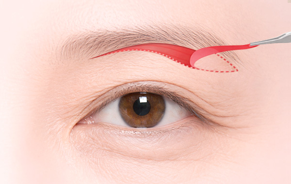 Upper Blepharoplasty in Korea, RINE Plastic Surgery