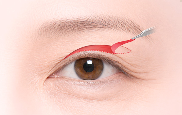 Upper Blepharoplasty in Korea, RINE Plastic Surgery