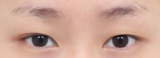 Non-Incisional Double Eyelid Surgery in Korea, RINE Plastic Surgery