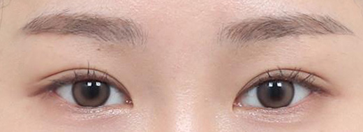 Non-Incisional Double Eyelid Surgery in Korea, RINE Plastic Surgery