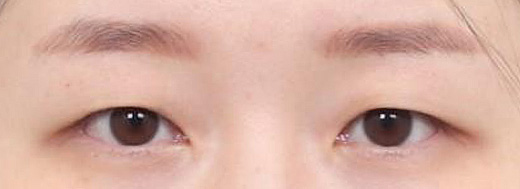 Non-Incisional Double Eyelid Surgery in Korea, RINE Plastic Surgery