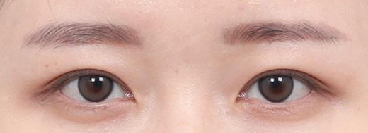 Non-Incisional Double Eyelid Surgery in Korea, RINE Plastic Surgery