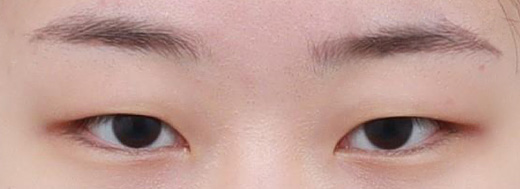 Non-Incisional Double Eyelid Surgery in Korea, RINE Plastic Surgery
