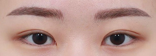 Non-Incisional Double Eyelid Surgery in Korea, RINE Plastic Surgery
