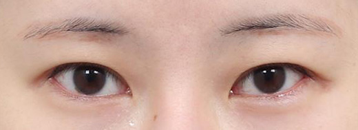 double eyelid revision surgery in korea rine plastic surgery
