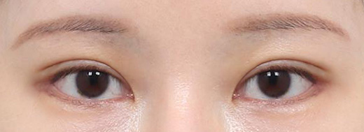double eyelid revision surgery in korea rine plastic surgery