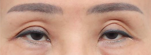 double eyelid revision surgery in korea rine plastic surgery