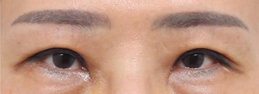 double eyelid revision surgery in korea rine plastic surgery